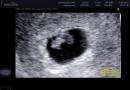 V katerem tednu postane zarodek viden na ultrazvoku?